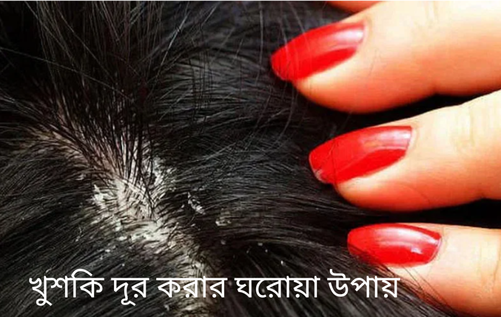 খুশকি দূর করার ঘরোয়া উপায়