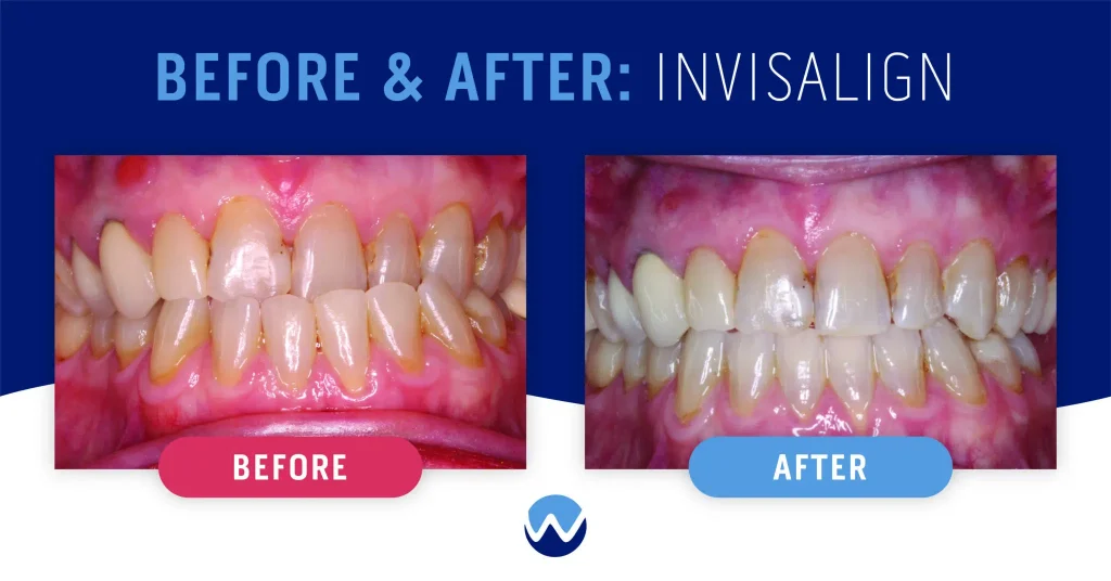Invisalign Before and After Underbite Transforming Smiles with Precision